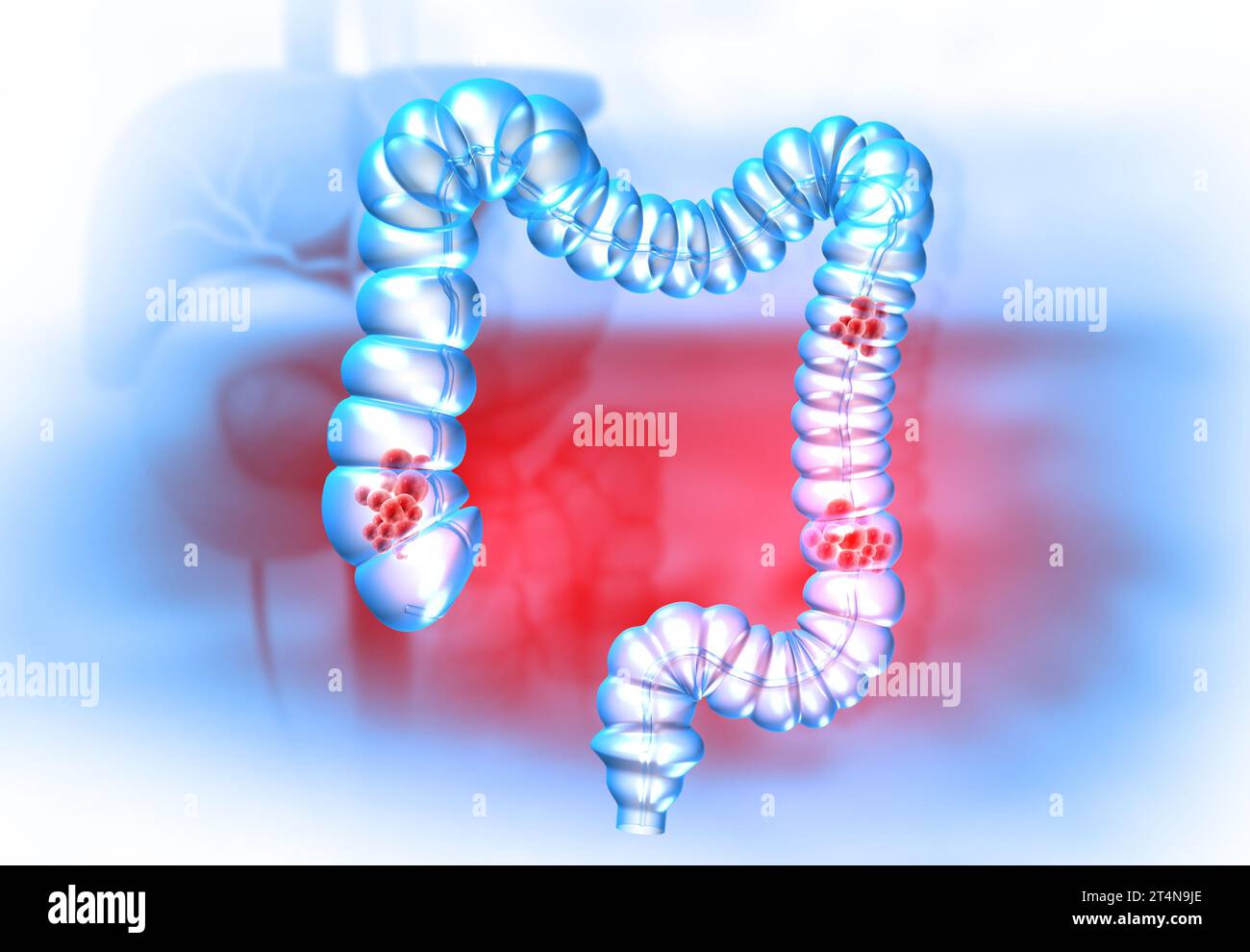 Concetto di cancro del colon su sfondo medico. illustrazione 3d. Foto Stock