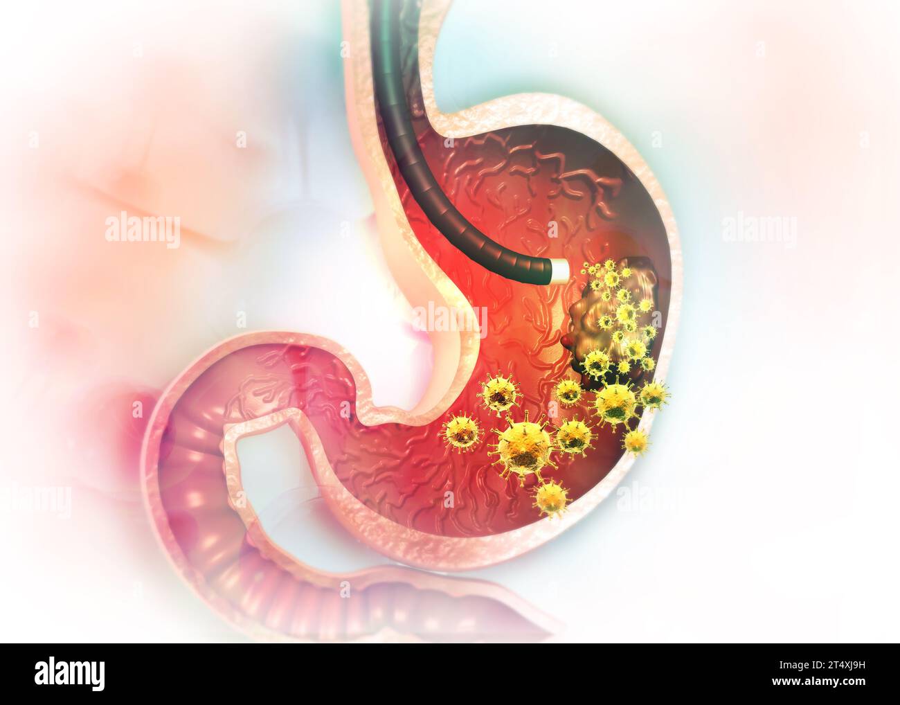 Cancro allo stomaco. illustrazione 3d. Foto Stock