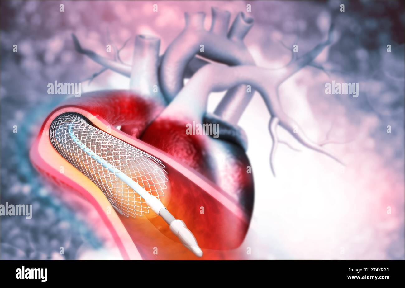 Angioplastica del cuore umano. illustrazione 3d. Foto Stock