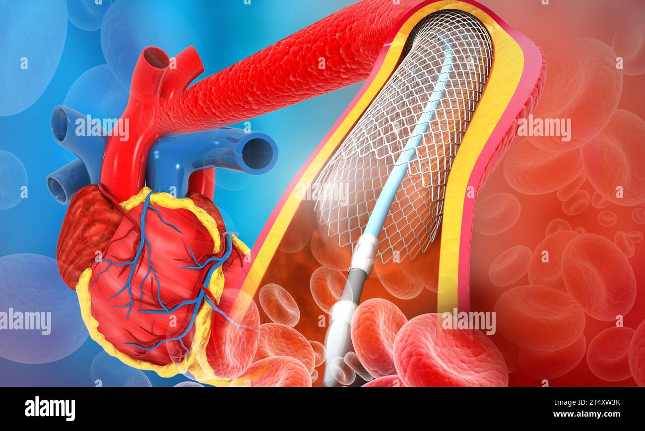 Angioplastica del cuore umano. illustrazione 3d. Foto Stock