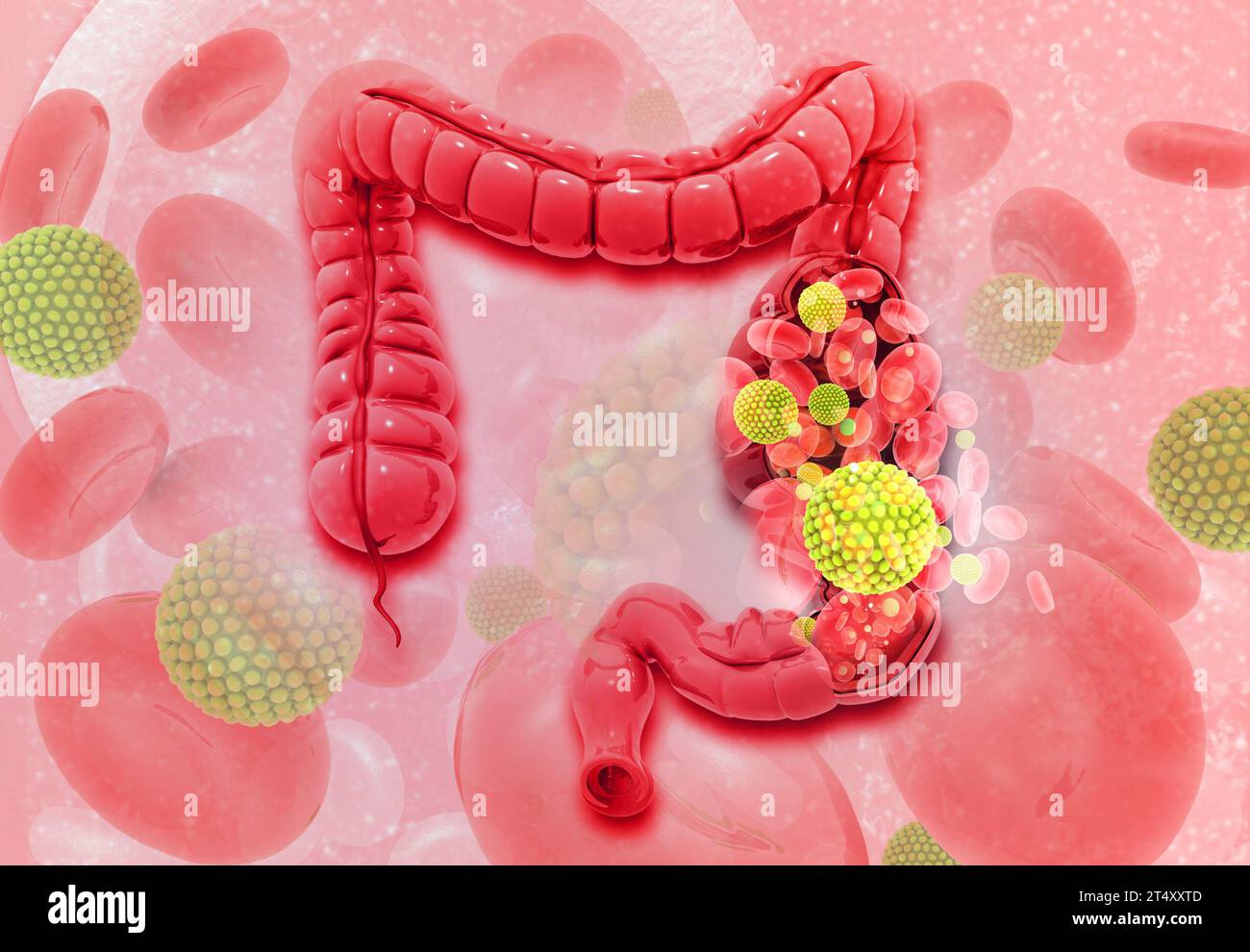 Cancro al colon. Cellule virali sul colon. illustrazione 3d. Foto Stock