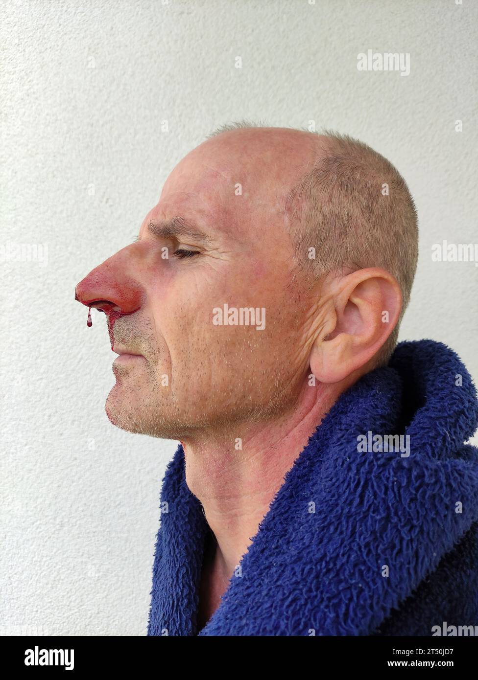 Sanguinoso naso di un uomo anziano Foto Stock