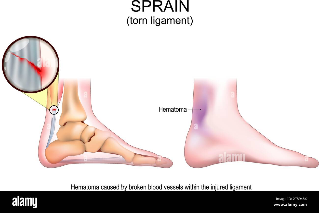 Distorsione. Lacerazione del legamento dopo una dolorosa torsione del piede. Segni e sintomi di una lesione del tessuto molle. Danno muscolare, lacerazione del tendine, descrizione del problema dei legamenti. Illustrazione Vettoriale