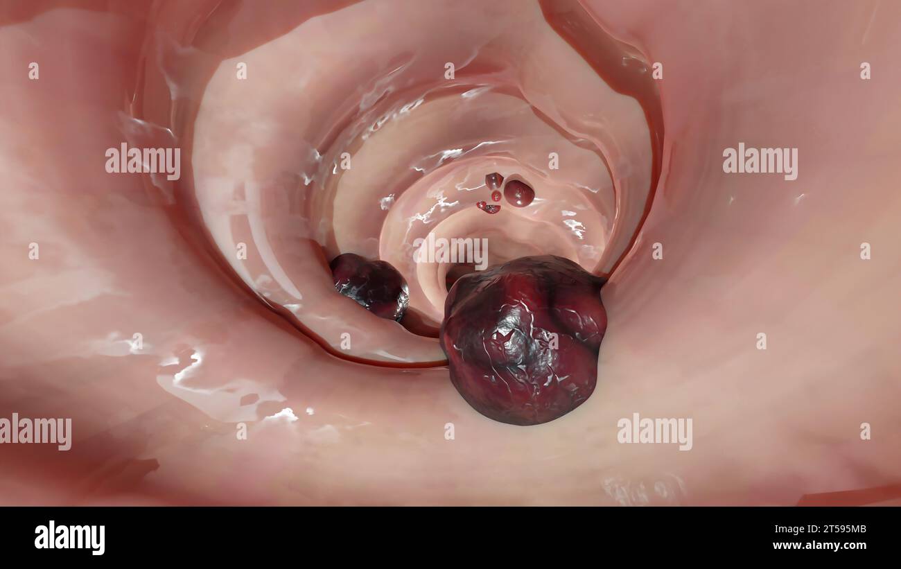 Cancro colorettale, tumore maligno dell'intestino, endoscopio all'interno della colonscopia, intestino intestinale, rimozione dei polipi del colon, ricerca dei polipi del colon, polipectomia, Foto Stock