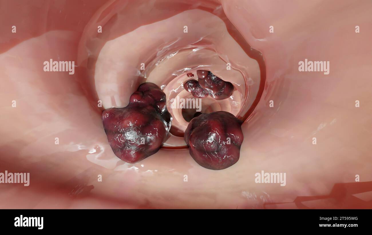 Cancro colorettale, tumore maligno dell'intestino, endoscopio all'interno della colonscopia, intestino intestinale, rimozione dei polipi del colon, ricerca dei polipi del colon, polipectomia, Foto Stock