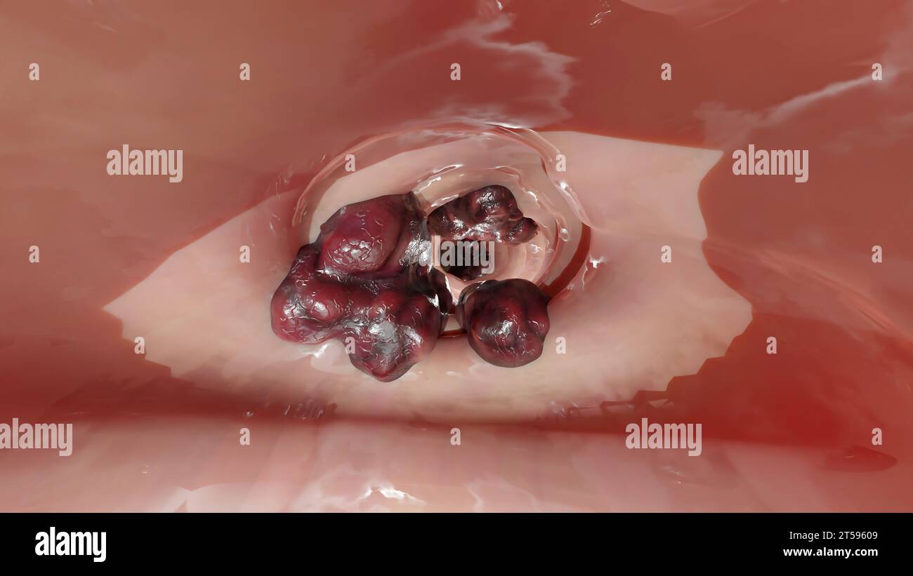 Cancro colorettale, tumore maligno dell'intestino, endoscopio all'interno della colonscopia, intestino intestinale, rimozione dei polipi del colon, ricerca dei polipi del colon, polipectomia, Foto Stock