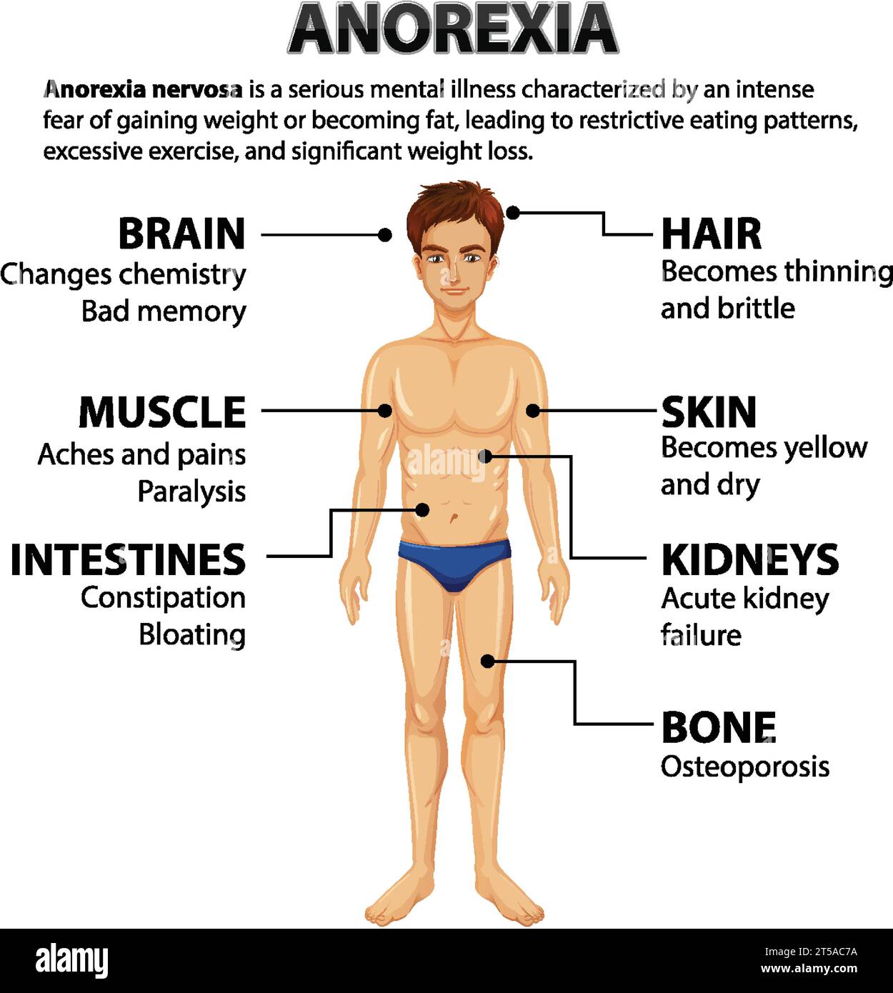 Illustrazione che mostra l'impatto dell'anoressia su varie funzioni del corpo Illustrazione Vettoriale