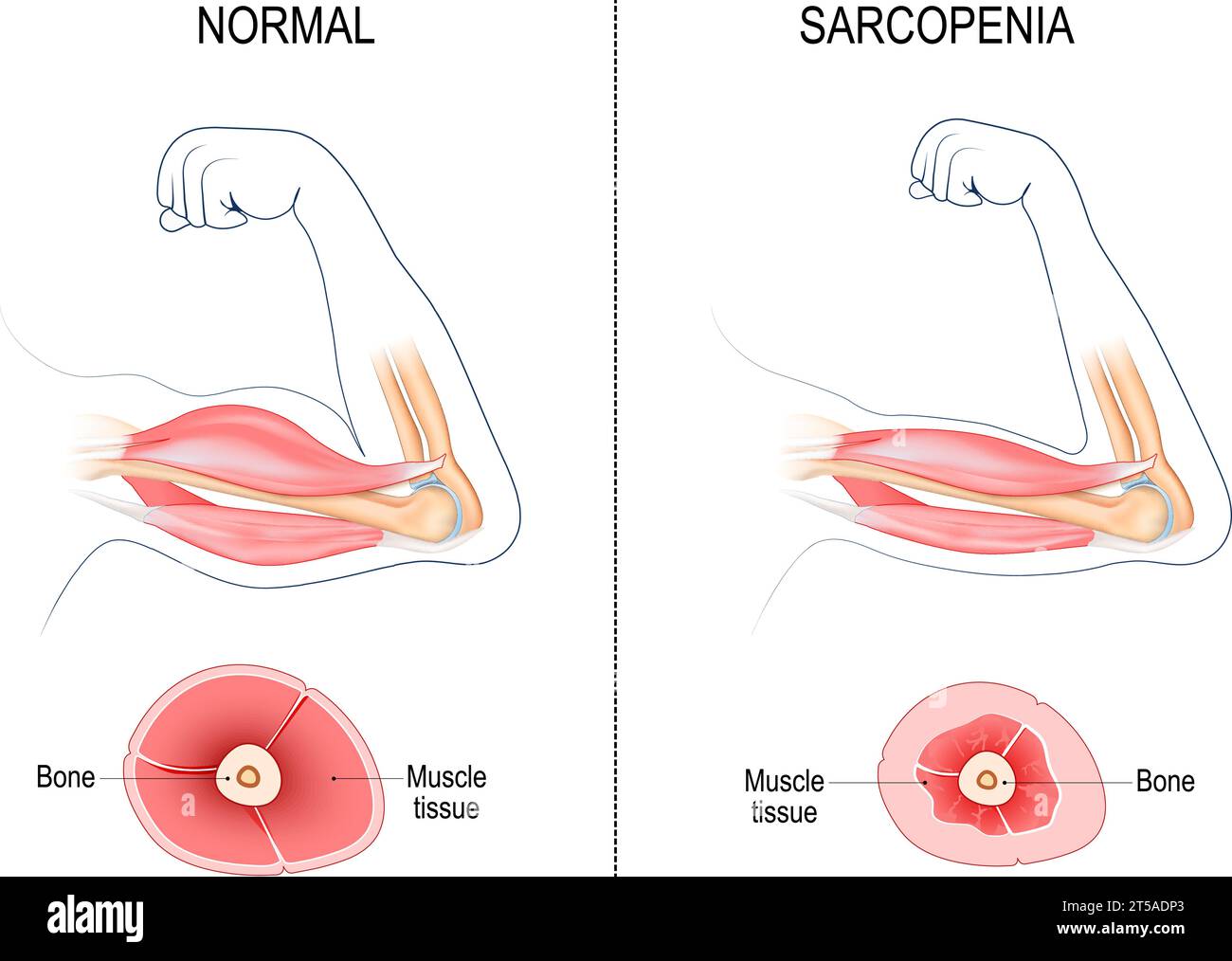 Sarcopenia. Atrofia muscolare correlata all'età. Confronto e differenza tra la normale perdita di braccio e muscolo. Sezione trasversale di Muscle of Young Active Person, Illustrazione Vettoriale