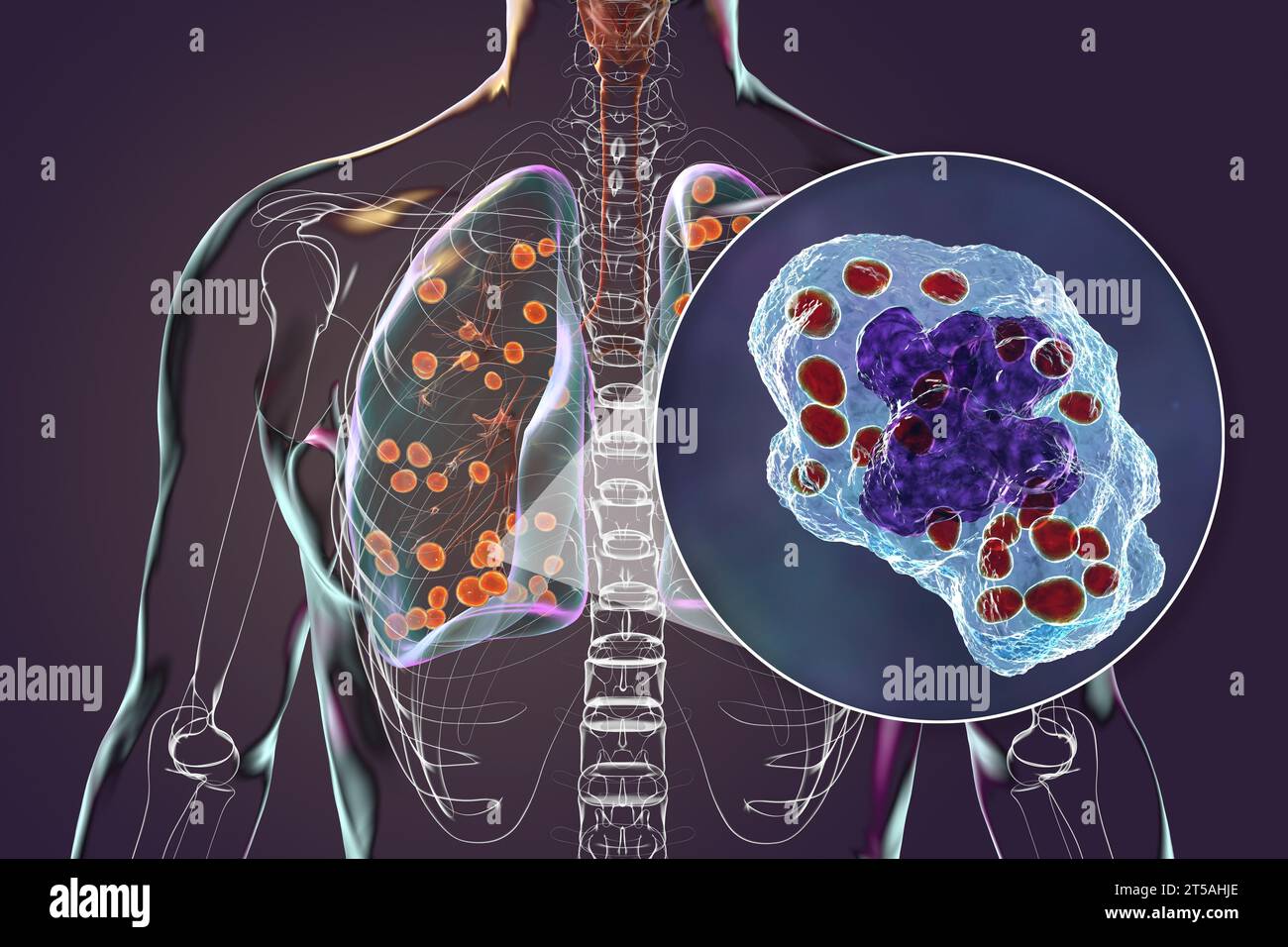 Istoplasmosi polmonare, illustrazione Foto Stock