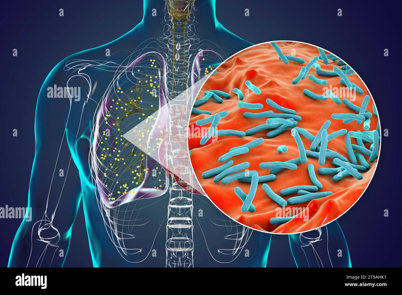 Polmoni affetti da tubercolosi miliare, illustrazione Foto Stock