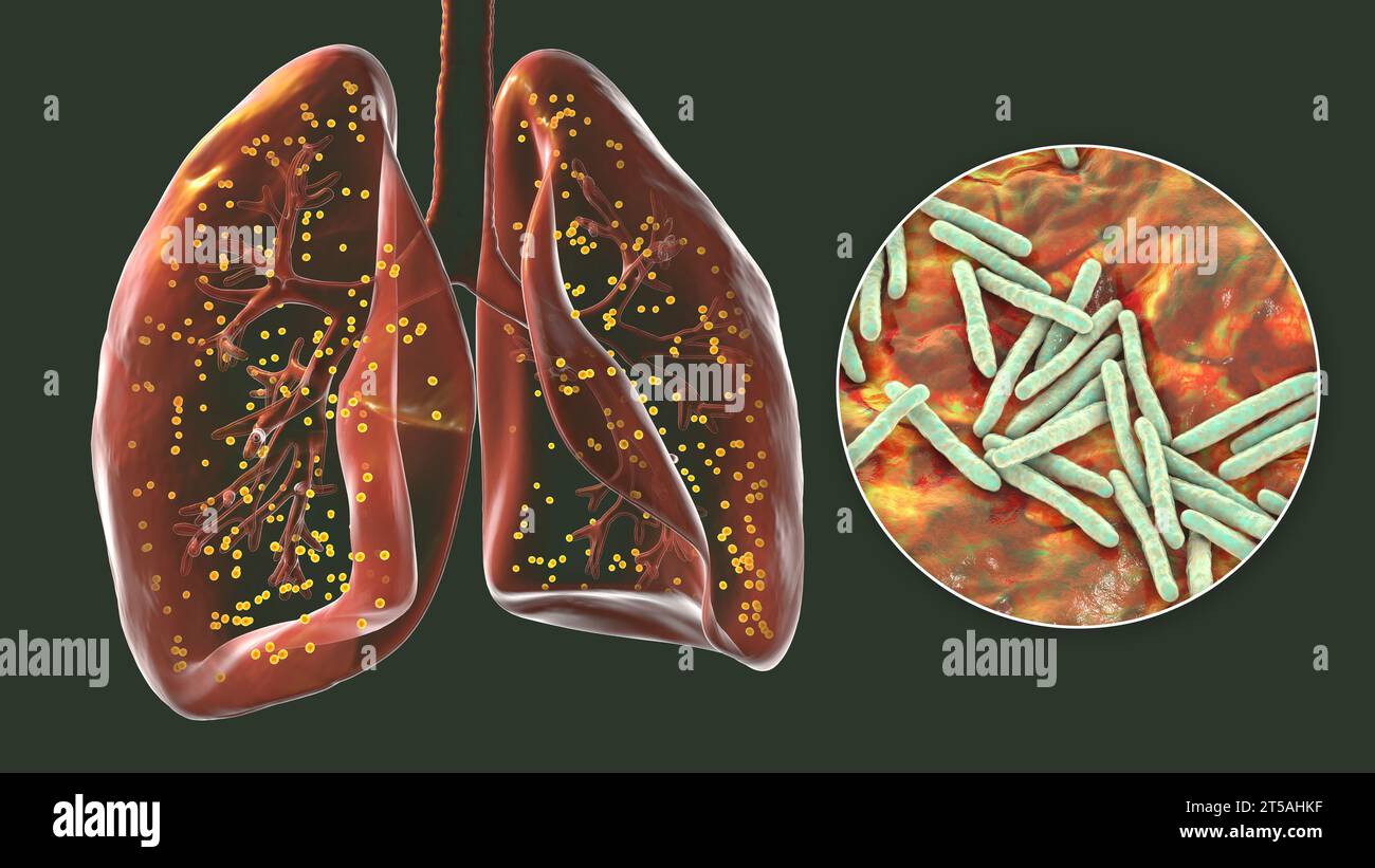 Polmoni affetti da tubercolosi miliare, illustrazione Foto Stock