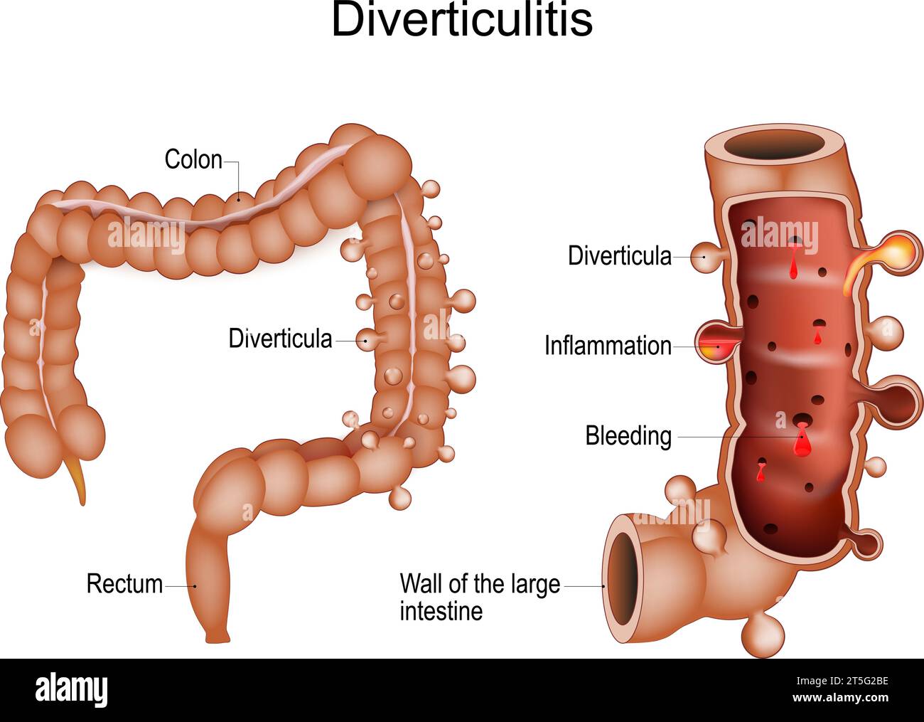 Diverticolite del colon. Sezione trasversale del colon con sanguinamento e infiammazione di sacche o diverticoli anomali. malattia gastrointestinale. La umana Illustrazione Vettoriale