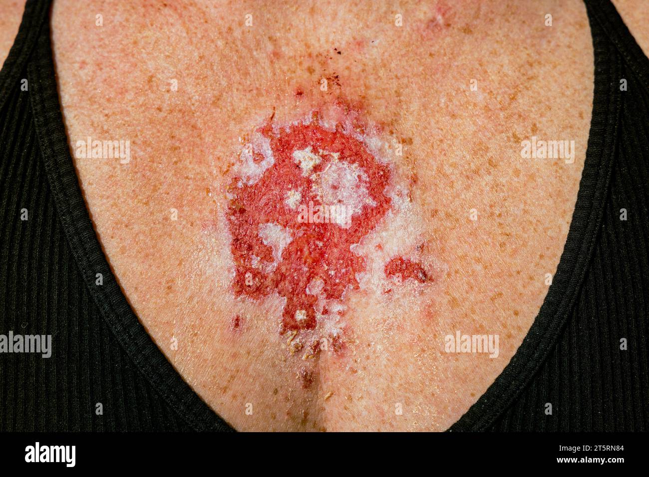 Carcinoma superficiale delle cellule basali che reagisce al farmaco con crema imiquimod dopo un trattamento coerente che mostra lesione rossa sul torace femminile caucasica degli anni '30. Foto Stock