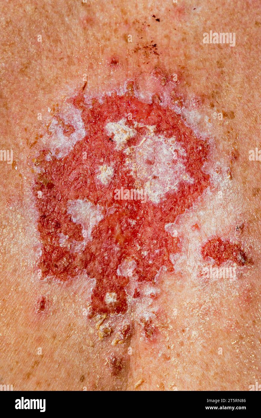 Carcinoma superficiale delle cellule basali che reagisce al farmaco con crema imiquimod dopo un trattamento coerente che mostra lesione rossa sul torace femminile caucasica degli anni '30. Foto Stock