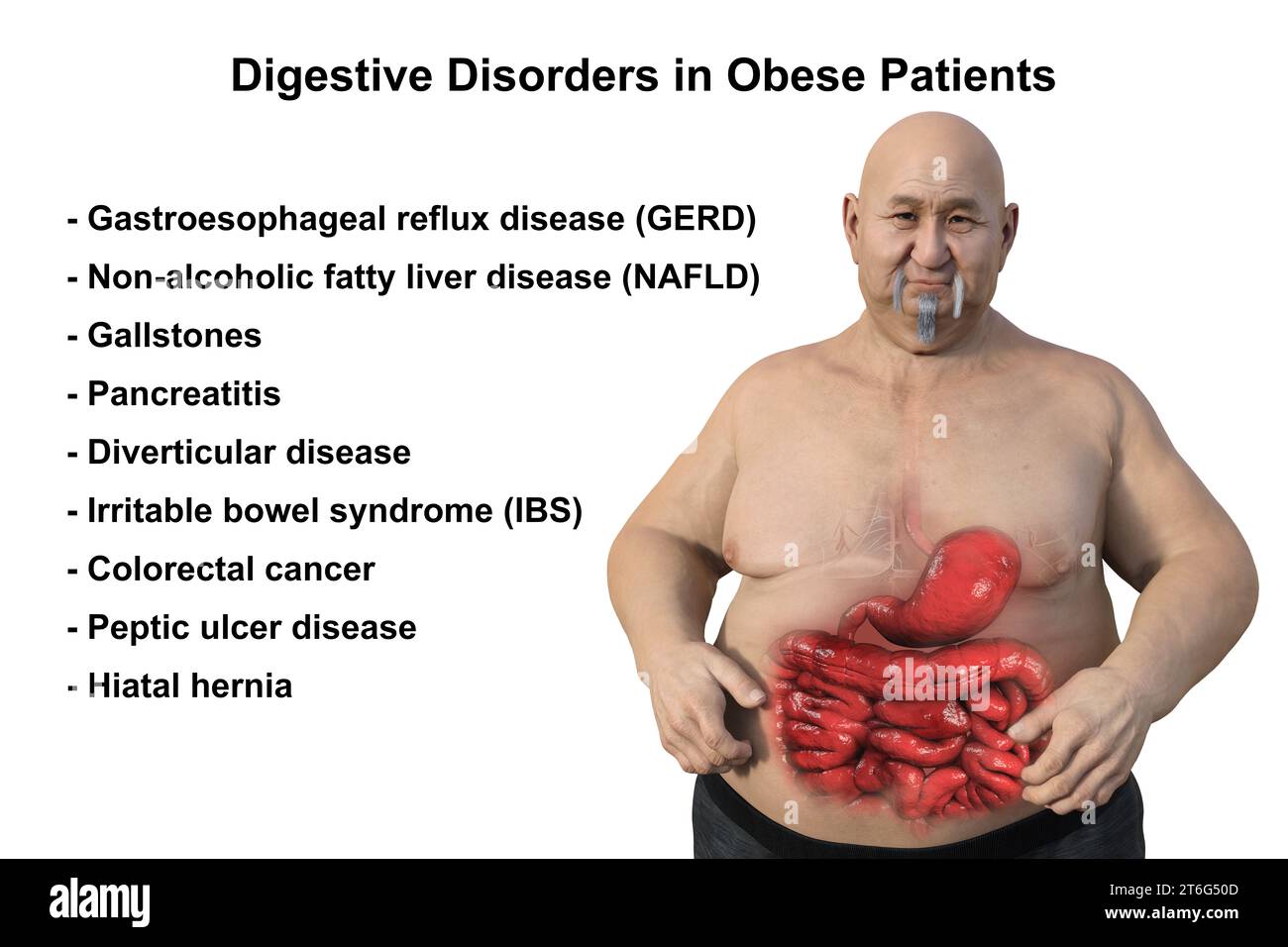 Una dettagliata illustrazione medica 3D di un uomo in sovrappeso con pelle trasparente, rivelando il sistema digestivo ed evidenziando i problemi digestivi Foto Stock