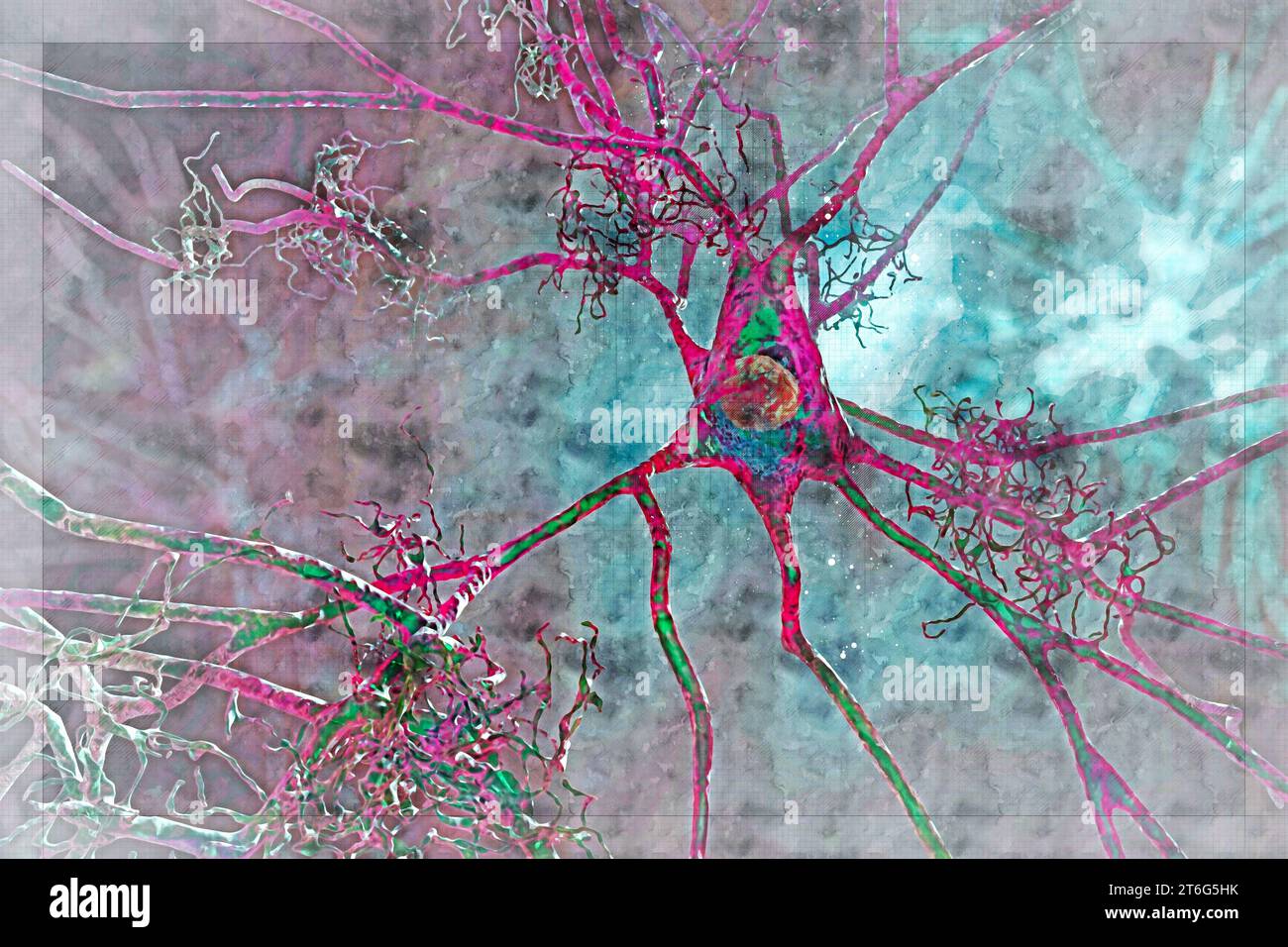 Neuroni in demenza. Malattia di Alzheimer, malattia di Huntington. Placche amiloidi nel tessuto cerebrale, grovigli neurofibrillari e diostruzione di n neuronale Foto Stock