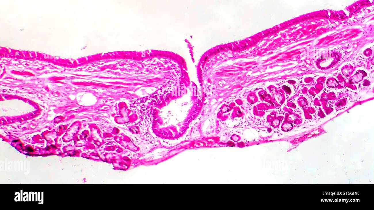 Fotomicrografia della metaplasia squamosa epiteliale bronchiale, che mostra la trasformazione delle cellule squamose nel rivestimento respiratorio. Foto Stock