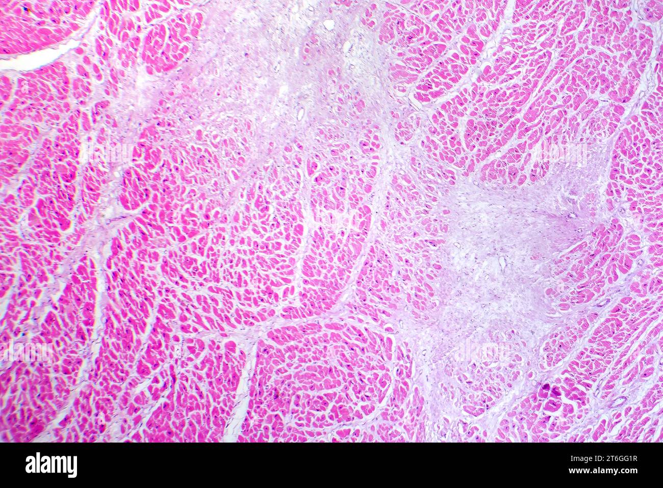 Fotomicrografia di infarto miocardico, mostrando tessuto cardiaco danneggiato a causa di un ridotto afflusso di sangue e morte cellulare. Foto Stock