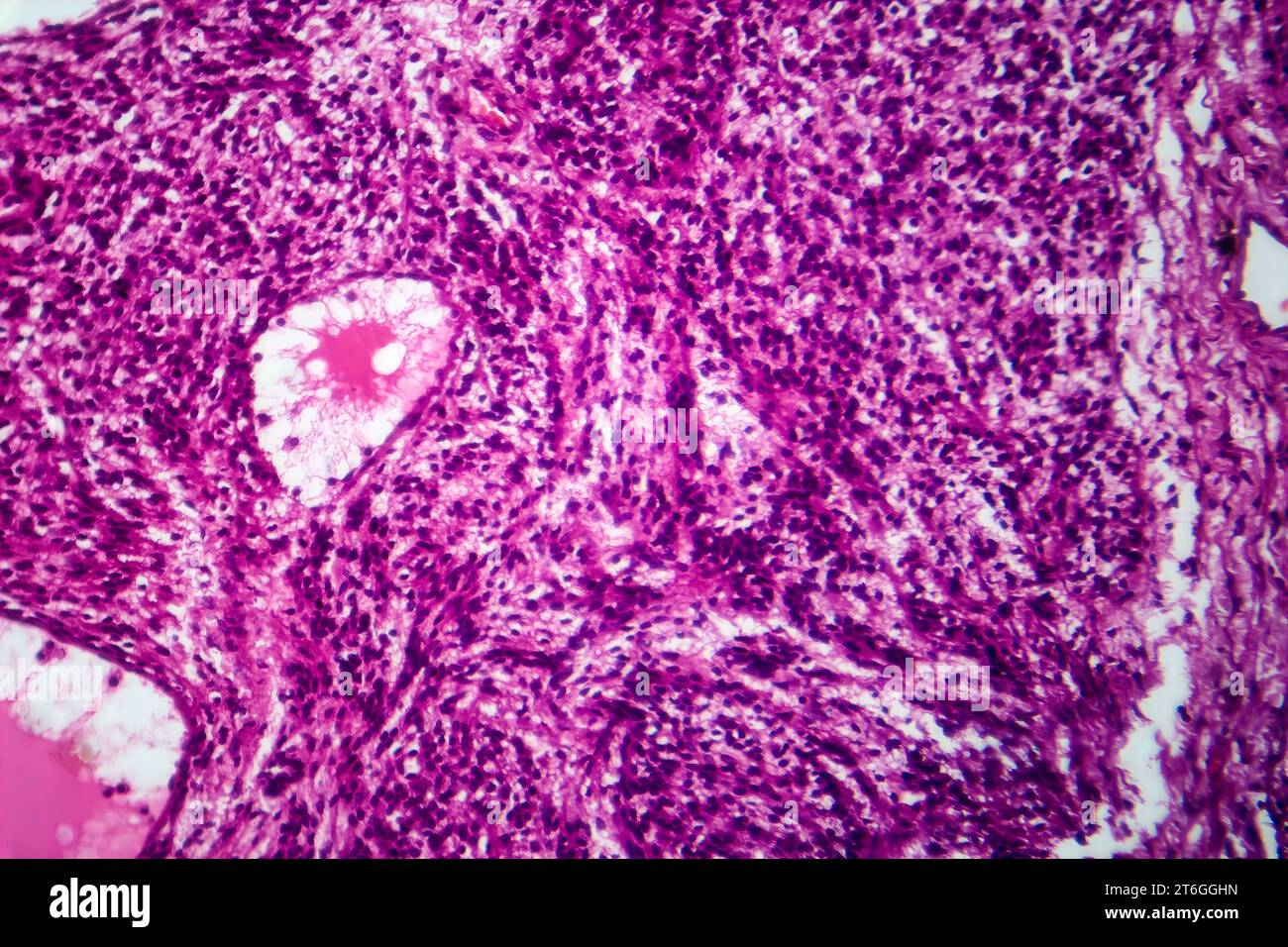 Fotomicrografia del fibrosarcoma, che rivela fibroblasti maligni e tessuto connettivo ricco di collagene, caratteristica del cancro aggressivo dei tessuti molli. Foto Stock