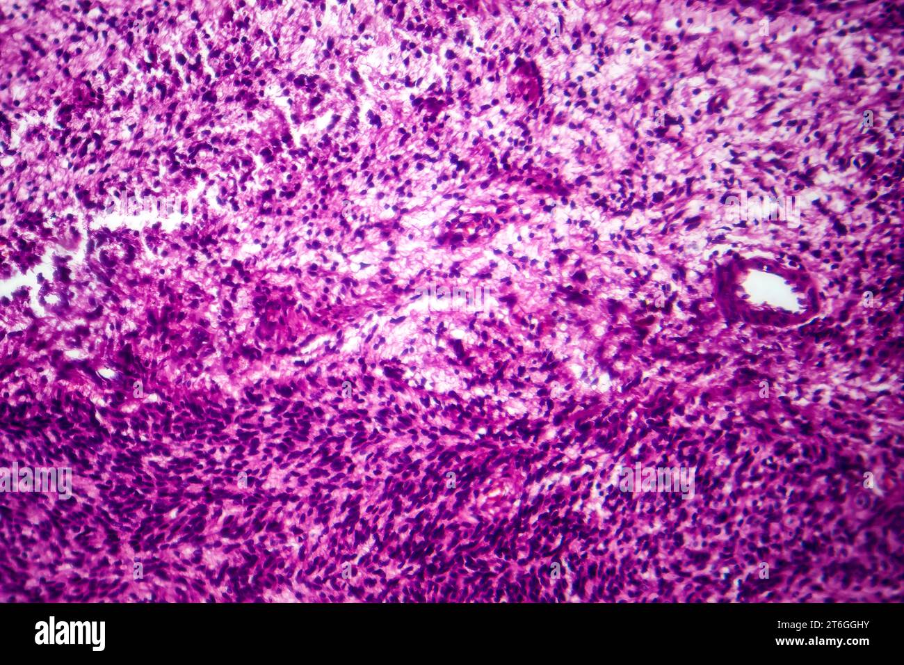 Fotomicrografia del fibrosarcoma, che rivela fibroblasti maligni e tessuto connettivo ricco di collagene, caratteristica del cancro aggressivo dei tessuti molli. Foto Stock