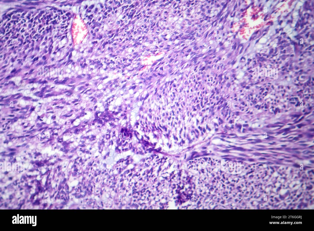Fotomicrografia del leiomioma, che illustra le cellule tumorali benigne del muscolo liscio all'interno del tessuto uterino. Foto Stock
