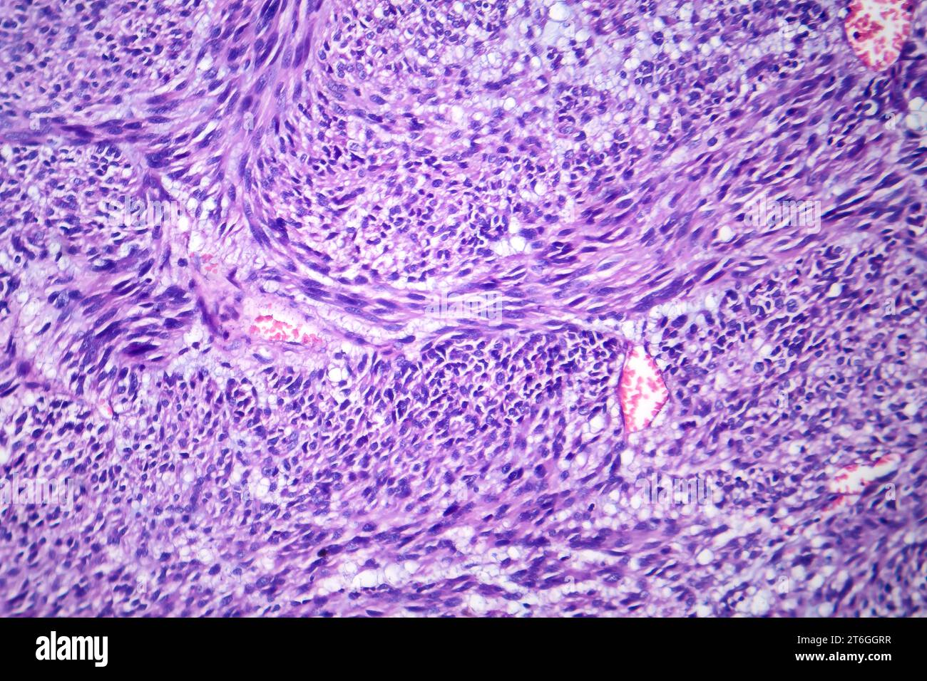 Fotomicrografia del leiomioma, che illustra le cellule tumorali benigne del muscolo liscio all'interno del tessuto uterino. Foto Stock