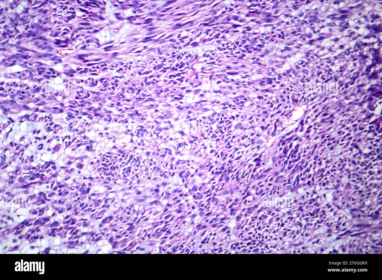 Fotomicrografia del leiomioma, che illustra le cellule tumorali benigne del muscolo liscio all'interno del tessuto uterino. Foto Stock