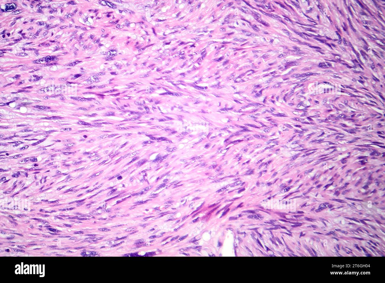 Fotomicrografia del leiomiosarcoma, raffigurante cellule tumorali maligne del muscolo liscio, indicativa di un tumore aggressivo dei tessuti molli. Foto Stock
