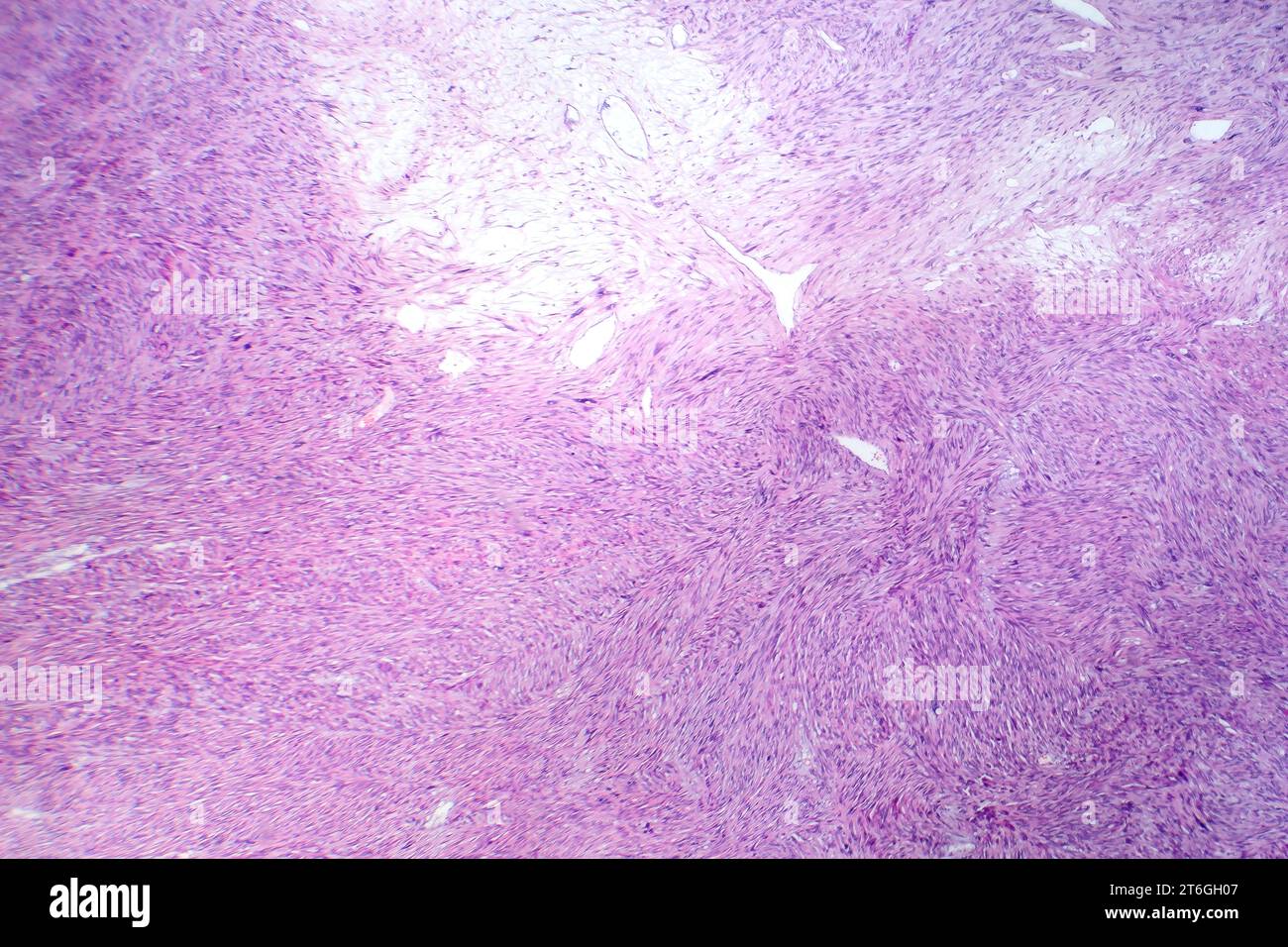 Fotomicrografia del leiomiosarcoma, raffigurante cellule tumorali maligne del muscolo liscio, indicativa di un tumore aggressivo dei tessuti molli. Foto Stock