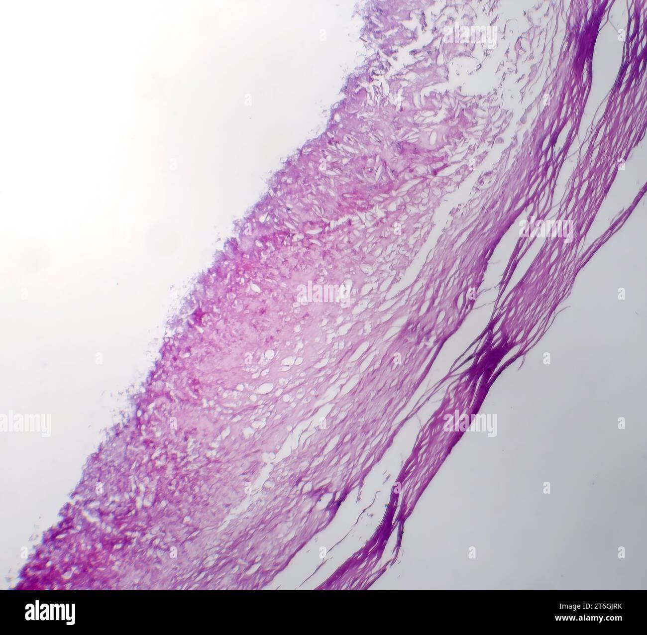 Fotomicrografia del melanoma, che mostra melanociti maligni, le cellule primarie responsabili del cancro cutaneo aggressivo. Foto Stock