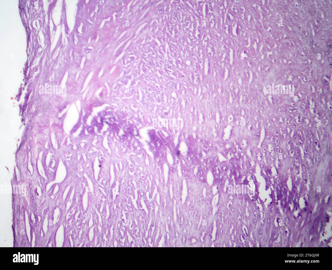 Fotomicrografia dell'aterosclerosi aortica, che rivela l'accumulo di placca e il restringimento dell'aorta dovuto a depositi di colesterolo. Foto Stock