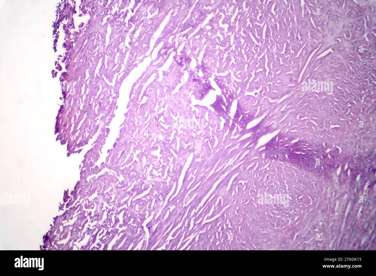 Fotomicrografia dell'aterosclerosi aortica, che rivela l'accumulo di placca e il restringimento dell'aorta dovuto a depositi di colesterolo. Foto Stock