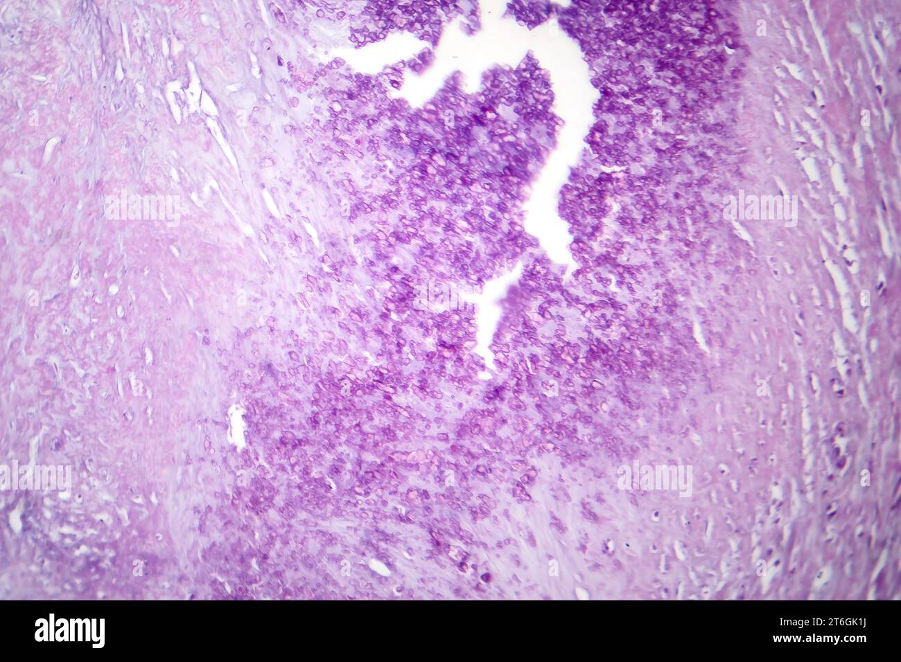 Fotomicrografia dell'aterosclerosi aortica, che rivela l'accumulo di placca e il restringimento dell'aorta dovuto a depositi di colesterolo. Foto Stock