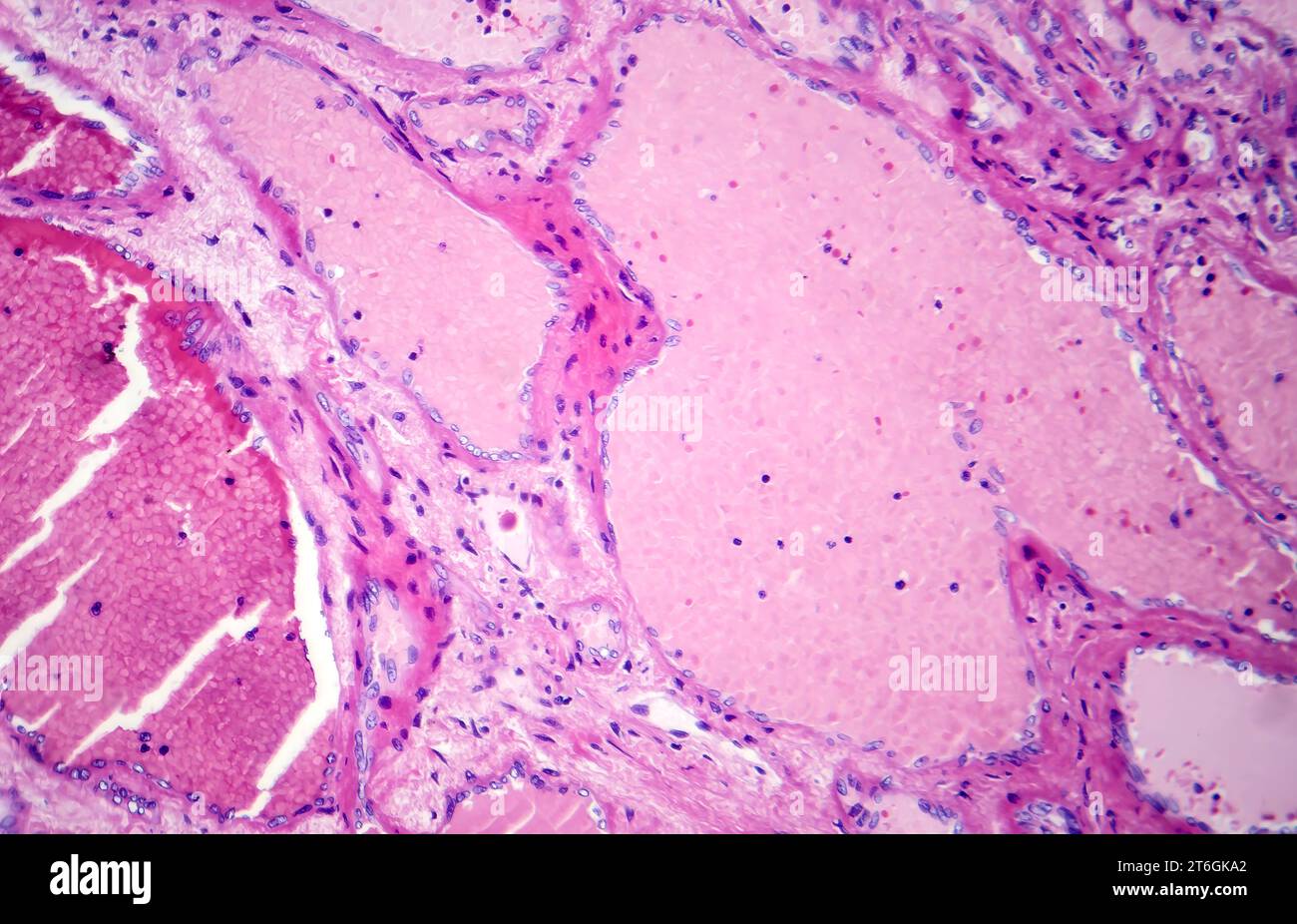 Fotomicrografia di emangioma cavernoso epatico, raffigurante vasi sanguigni dilatati nel tessuto epatico, caratteristica di un tumore benigno. Foto Stock