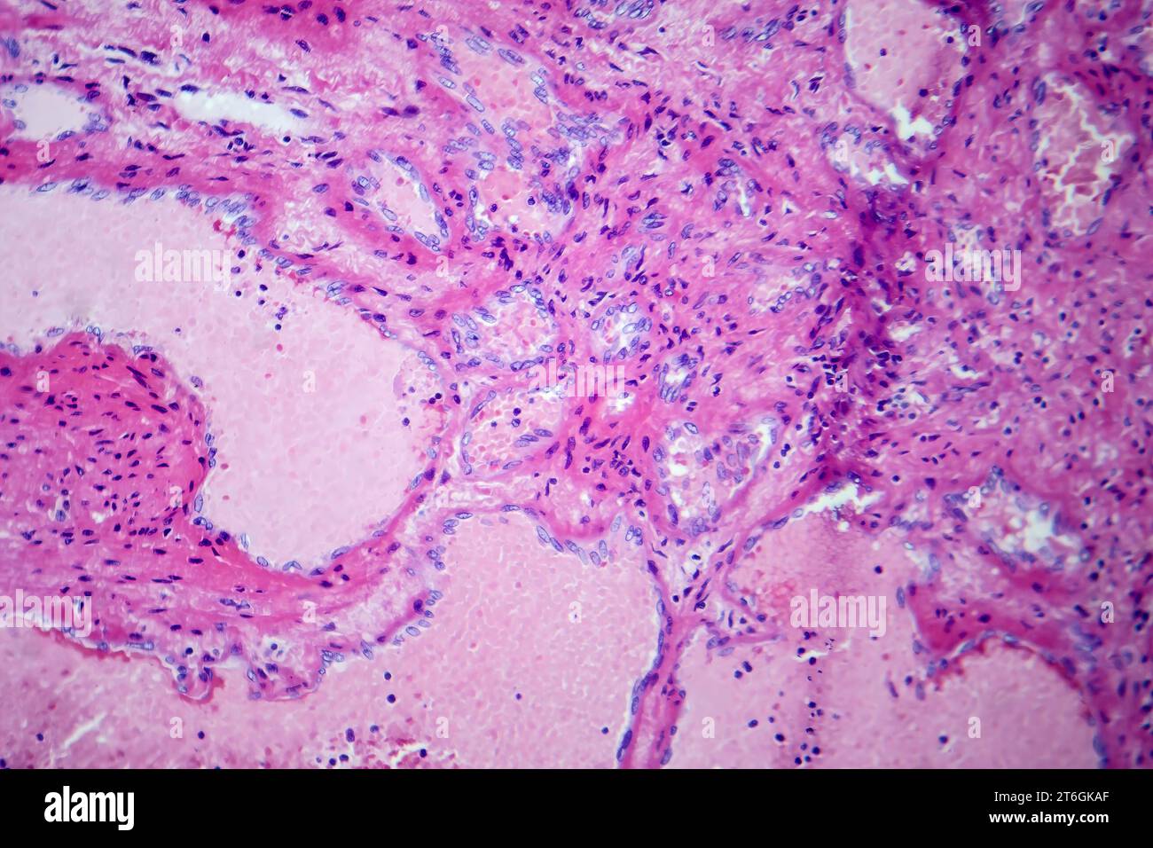 Fotomicrografia di emangioma cavernoso epatico, raffigurante vasi sanguigni dilatati nel tessuto epatico, caratteristica di un tumore benigno. Foto Stock