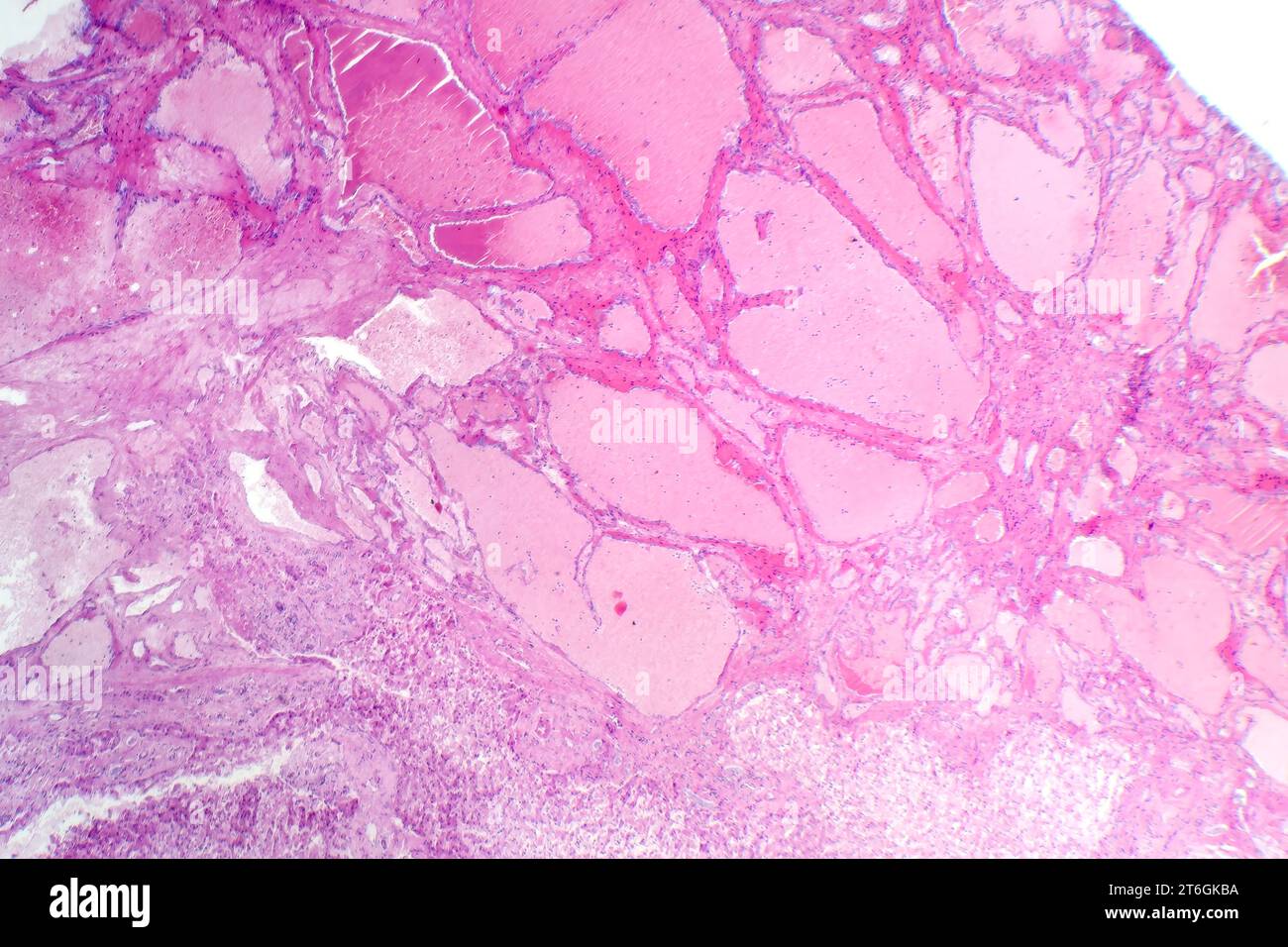 Fotomicrografia di emangioma cavernoso epatico, raffigurante vasi sanguigni dilatati nel tessuto epatico, caratteristica di un tumore benigno. Foto Stock