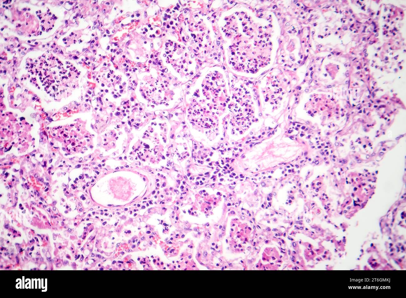 Fotomicrografia della polmonite lobare in fase epatica rossa, che mostra tessuto polmonare infiammato con epatite rossa caratteristica della malattia. Foto Stock