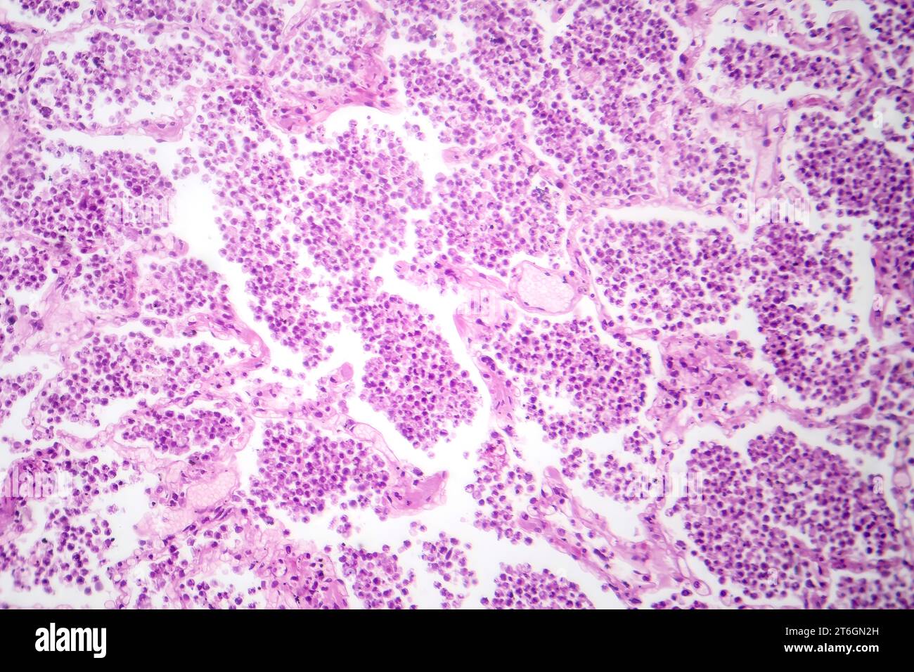 Fotomicrografia della polmonite lobare in fase epatica grigia, che rivela la transizione del tessuto polmonare con alveoli riempiti di essudato. Foto Stock