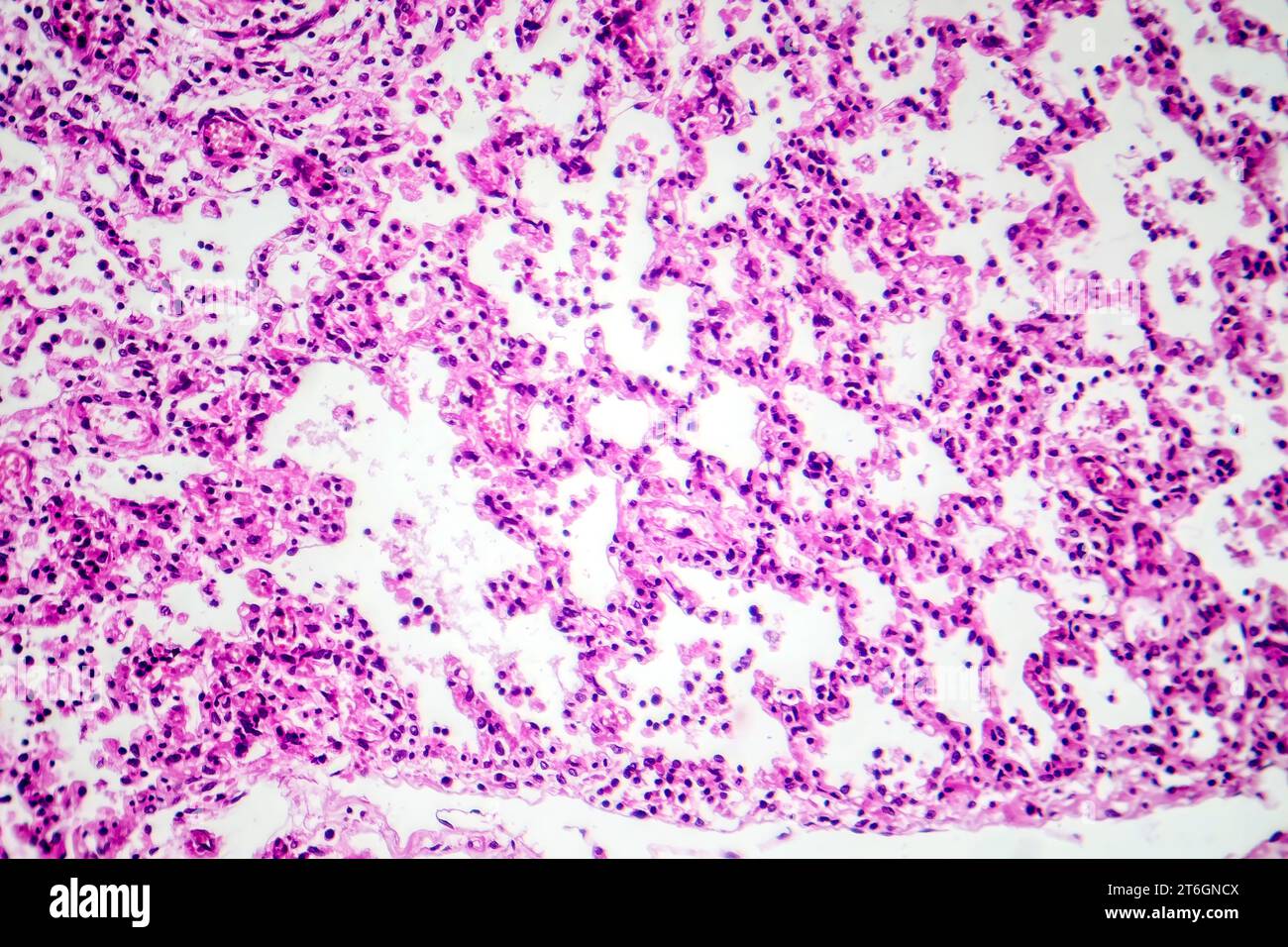 Fotomicrografia della broncopolmonite, che illustra l'infiammazione e il consolidamento del tessuto polmonare dovuto a infezione batterica. Foto Stock