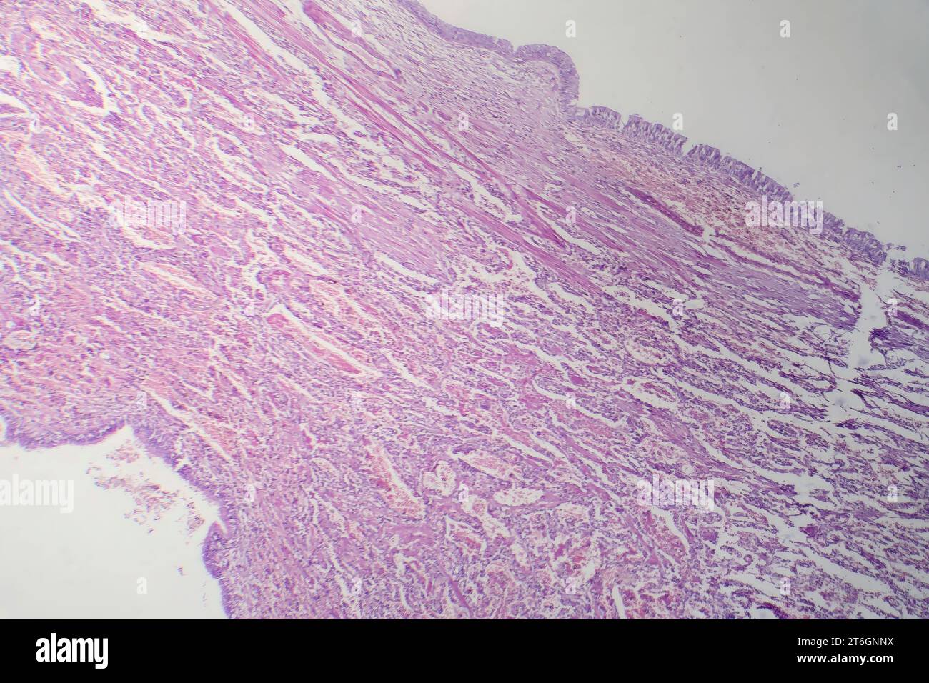 Fotomicrografia della polmonite virale, rivelando infiammazione e danno cellulare causato da un'infezione respiratoria virale. Foto Stock