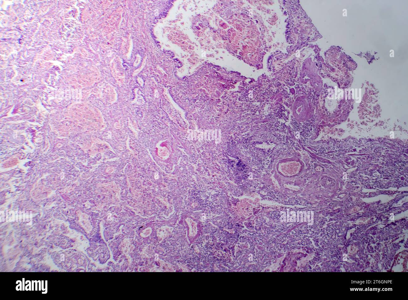 Fotomicrografia della polmonite virale, rivelando infiammazione e danno cellulare causato da un'infezione respiratoria virale. Foto Stock