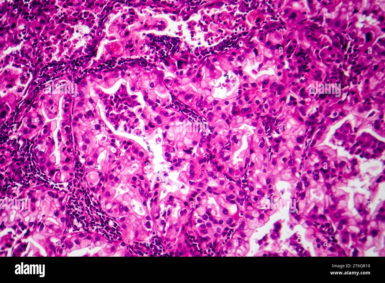Fotomicrografia del tessuto tumorale polmonare, che rivela le cellule maligne e la caratteristica di crescita anomala della neoplasia polmonare. Foto Stock