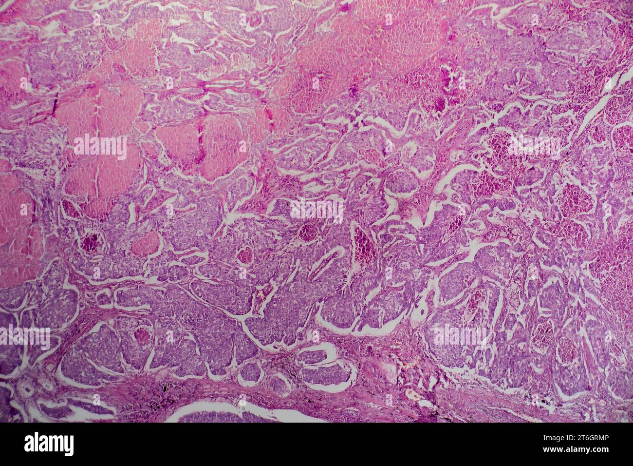 Fotomicrografia dell'adenocarcinoma polmonare, che illustra le cellule ghiandolari maligne caratteristiche del tipo più comune di cancro polmonare. Foto Stock