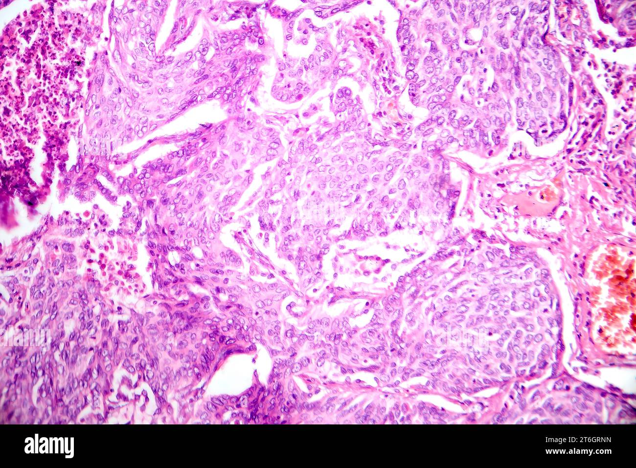 Fotomicrografia dell'adenocarcinoma polmonare, che illustra le cellule ghiandolari maligne caratteristiche del tipo più comune di cancro polmonare. Foto Stock