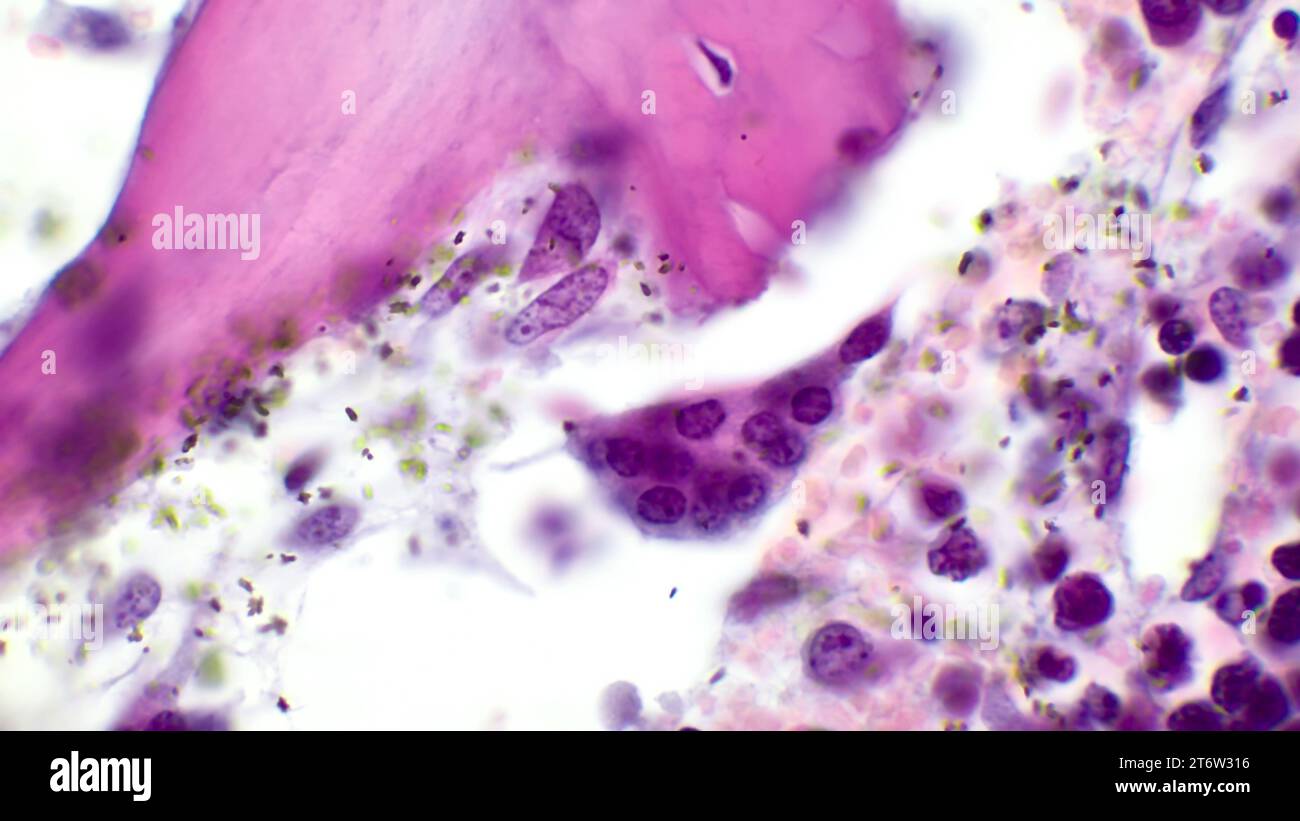 Osteoclasti nel midollo osseo rosso umano. L'osteoclasto è una cellula multinucleata. Colorazione con ematossilina ed eosina. Ingrandimento - 1000. Foto Stock
