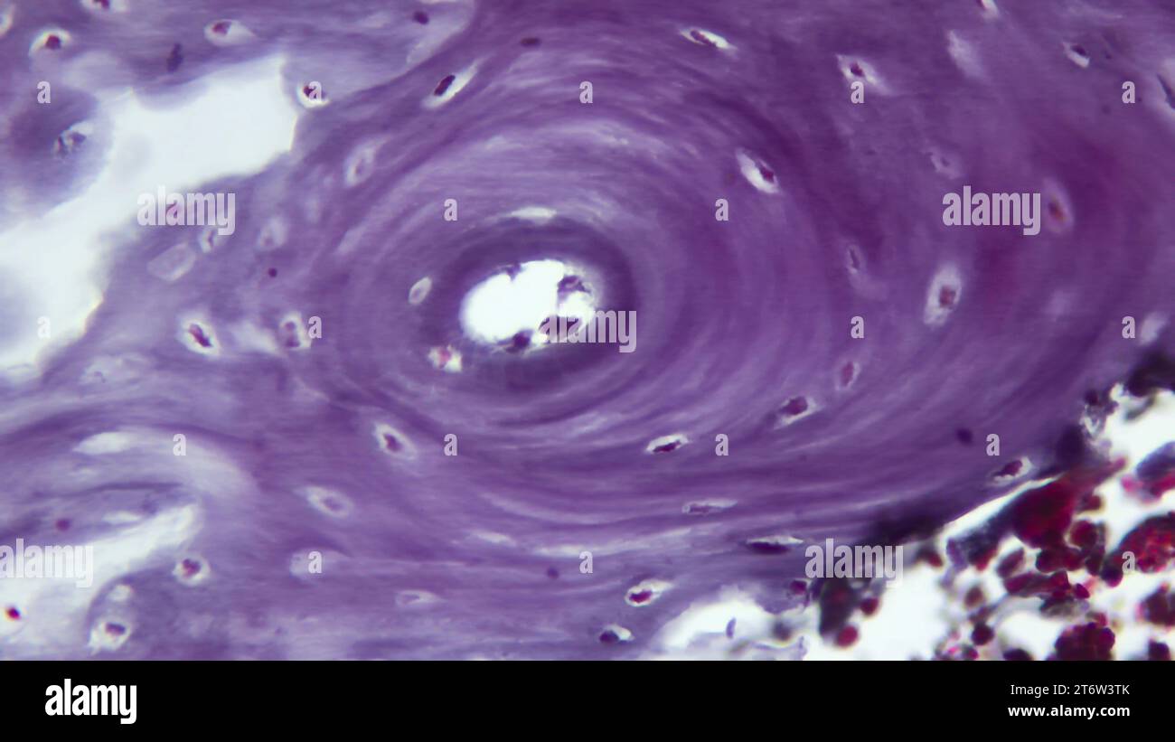 Sezione trasversale attraverso l'osteon osseo umano e il canale haversiano. Vetrino istologico colorato con ematossilina ed eosina (H&e). Foto Stock