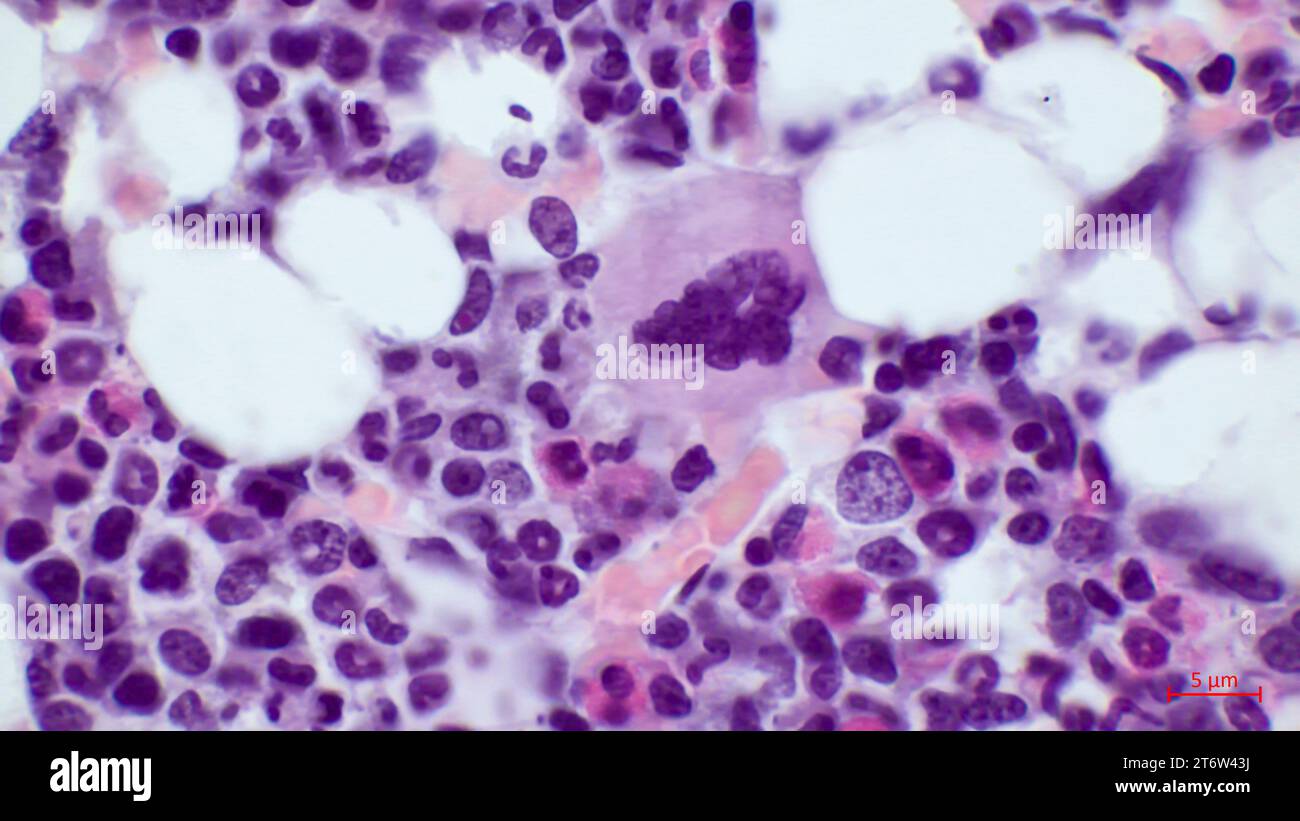 La cellula più grande nel midollo osseo rosso è il megacariocita (situato al centro). Colorazione con ematossilina ed eosina. Ingrandimento - 1000. Foto Stock