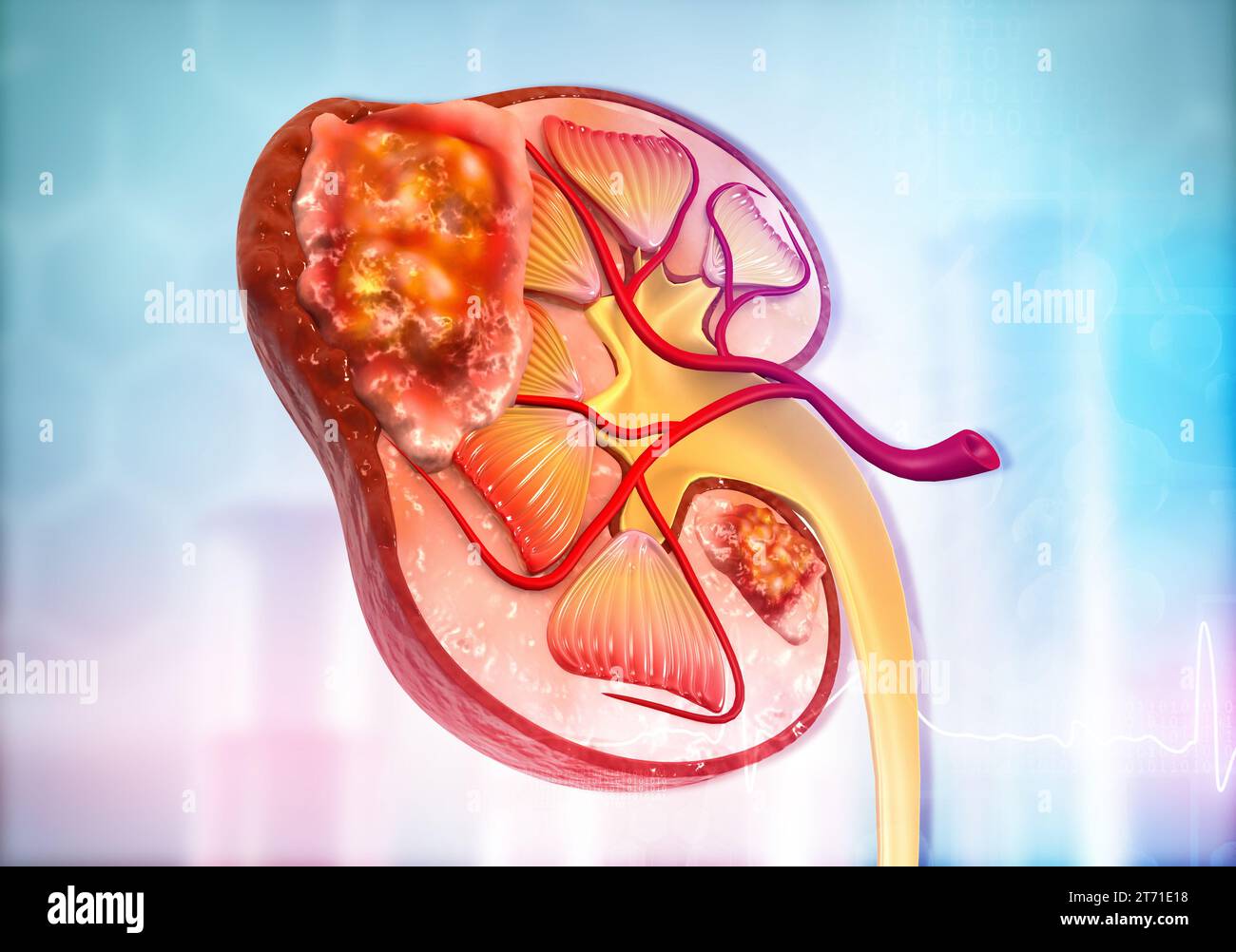 Rene umano malato in base alla scienza. illustrazione 3d. Foto Stock