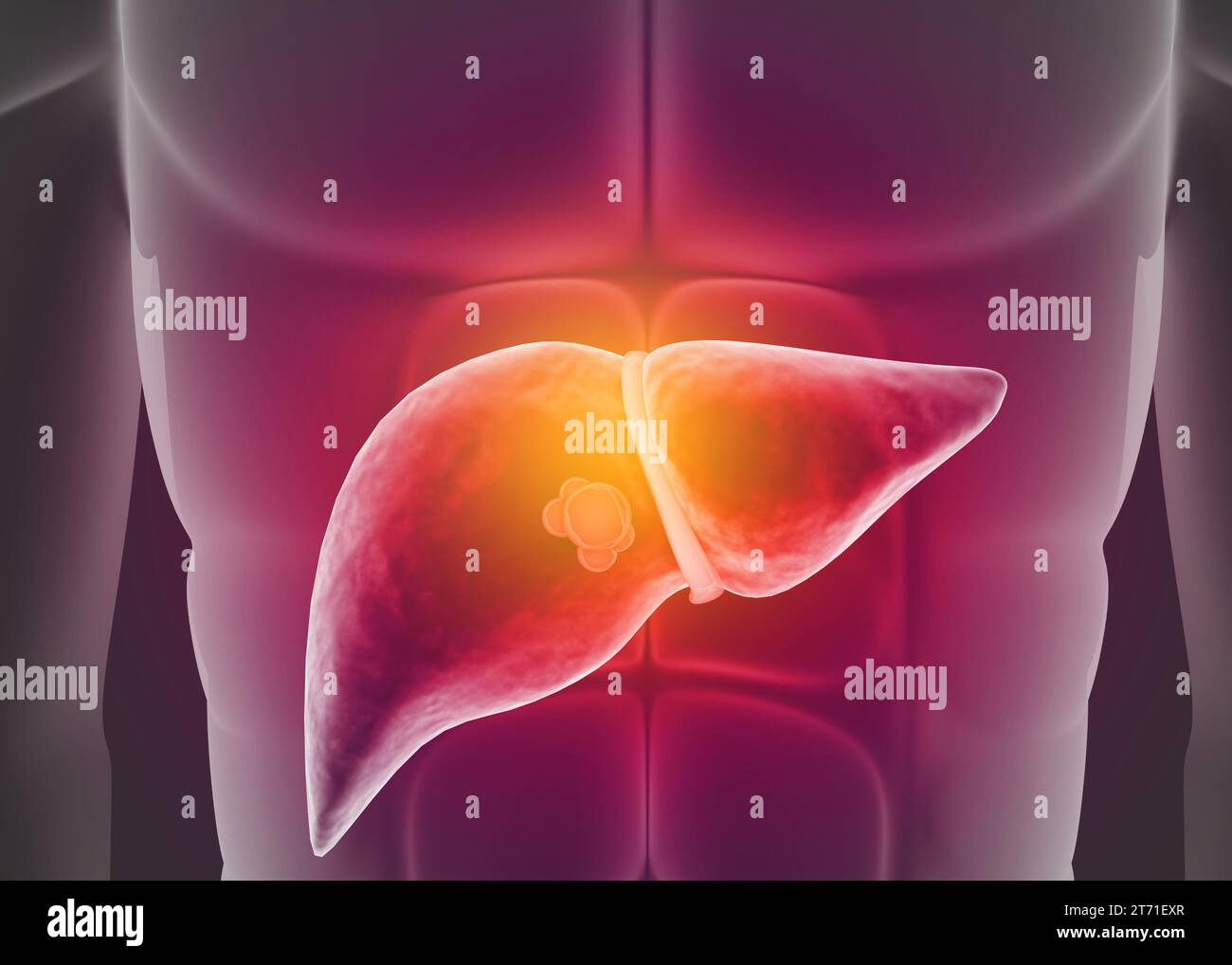 Fegato umano malato con corpo umano. illustrazione 3d. Foto Stock