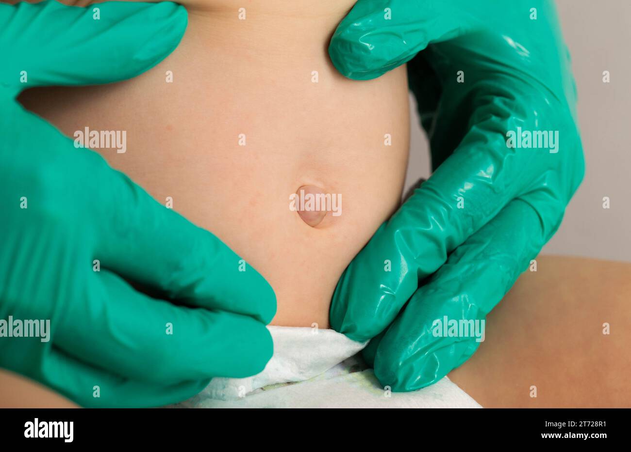 Le mani del medico in guanti medici verdi esaminano un'ernia ombelicale in un bambino, primo piano. Problemi Foto Stock